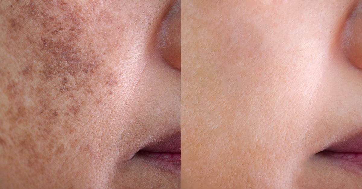 Hyperpigmentation: what is it?