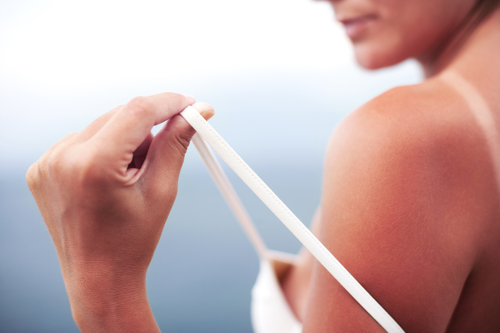 Last-minute remedies for sunburn